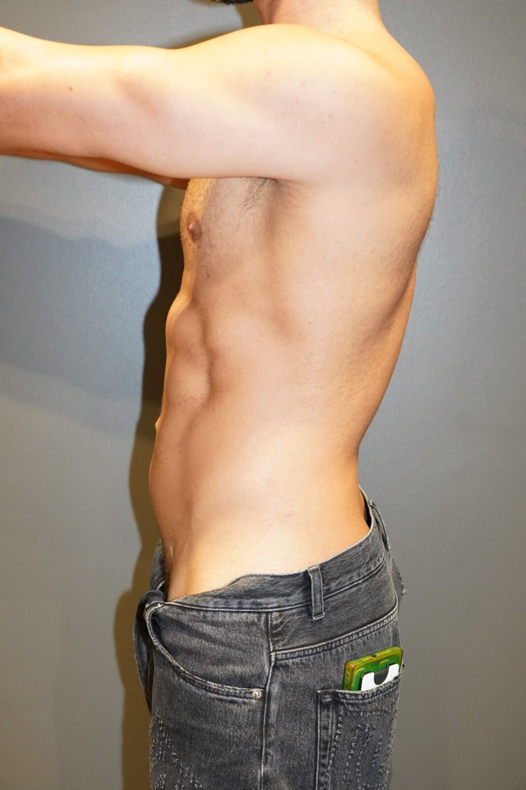 After photo - -90° view