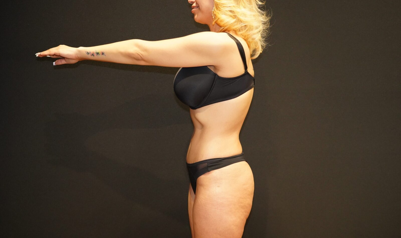 Tummy Tuck after photo — Modern