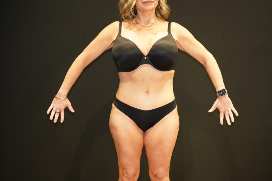 Tummy Tuck after photo — Modern
