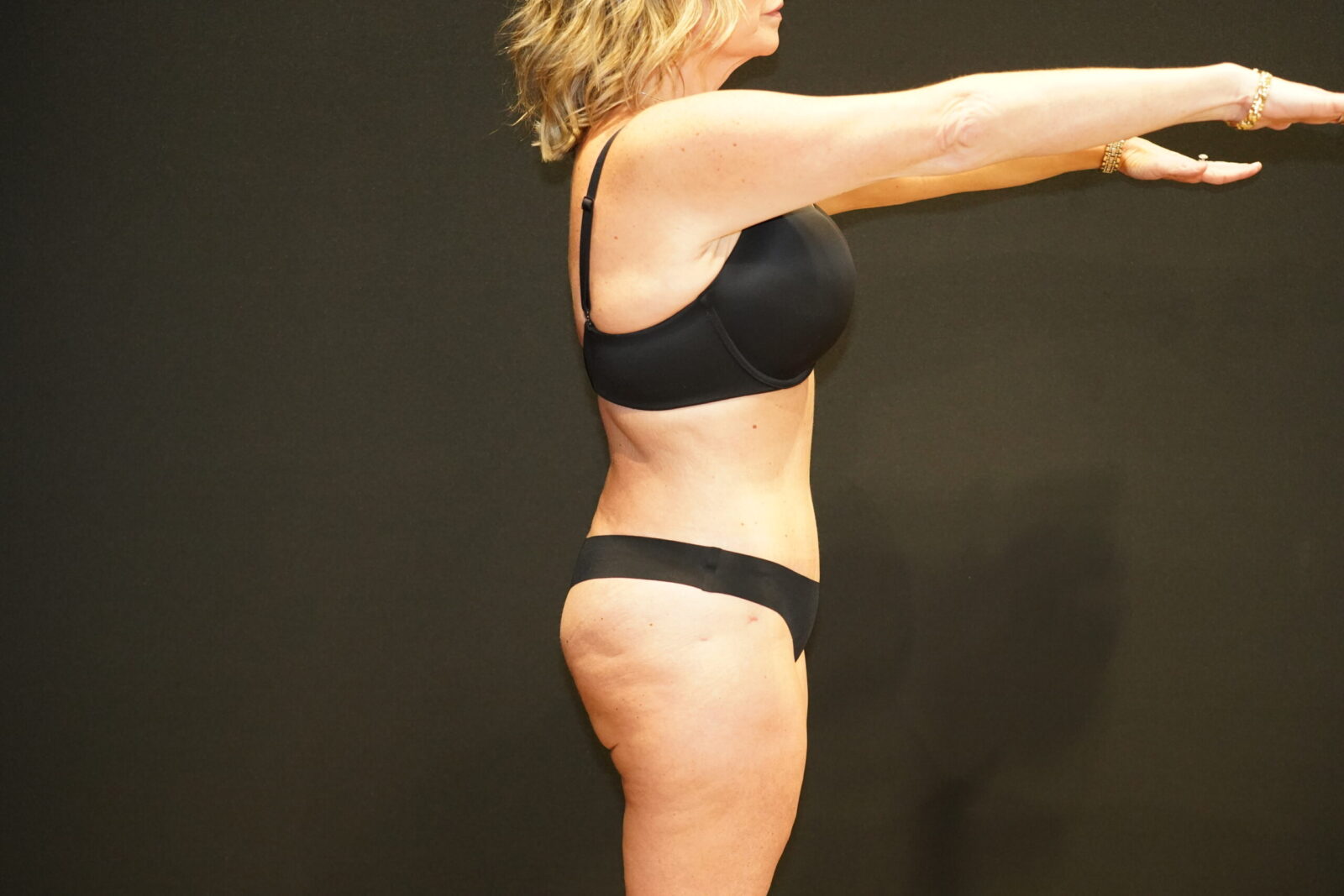 Tummy Tuck after photo — Modern