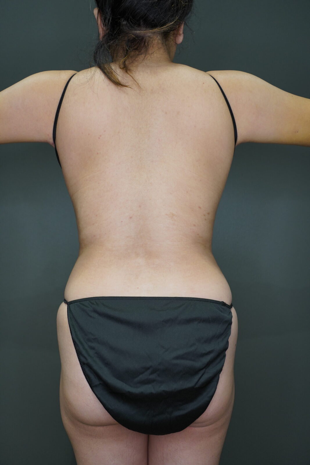 Body Liposuction & Contouring before photo — Modern
