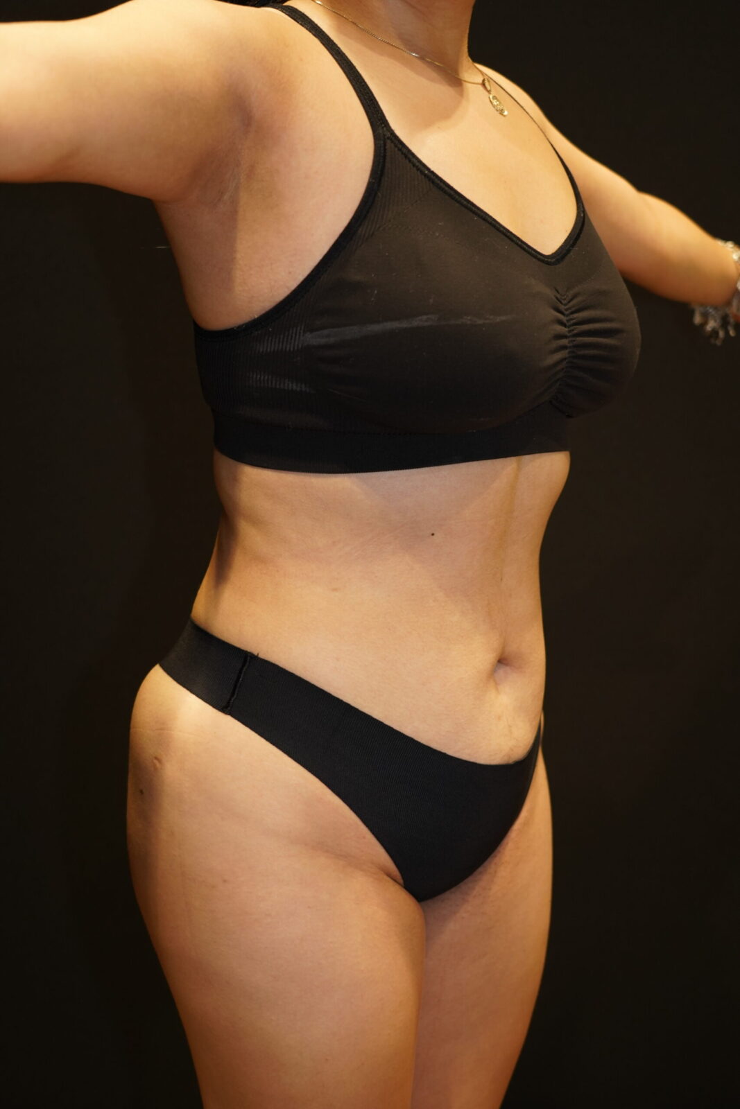 Body Liposuction & Contouring after photo — Modern