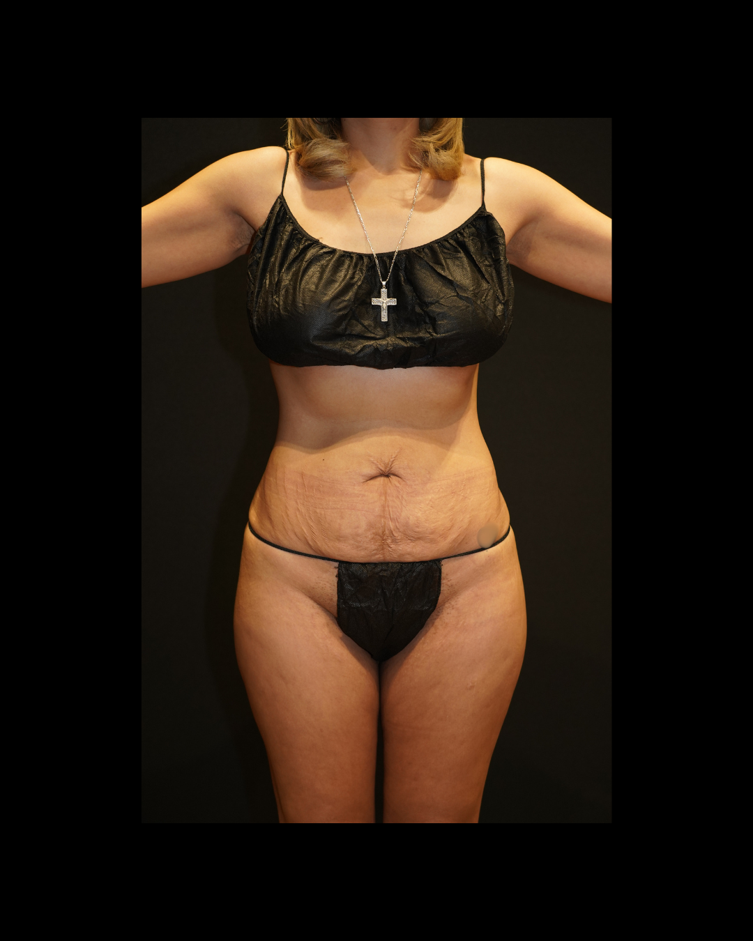 Case--9979 | Before Tummy Tuck