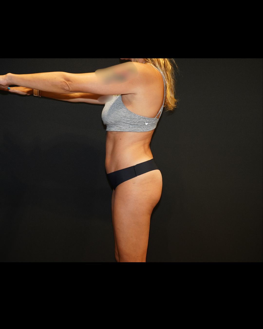 Case--8958 | After Tummy Tuck 4