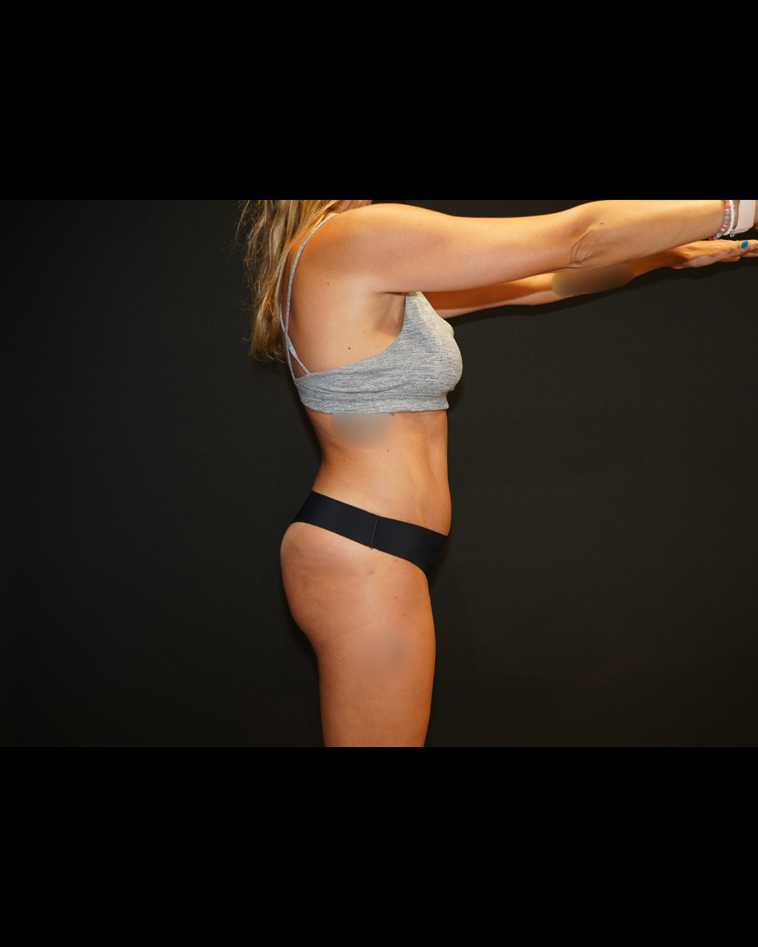 Case--8958 | After Tummy Tuck 2