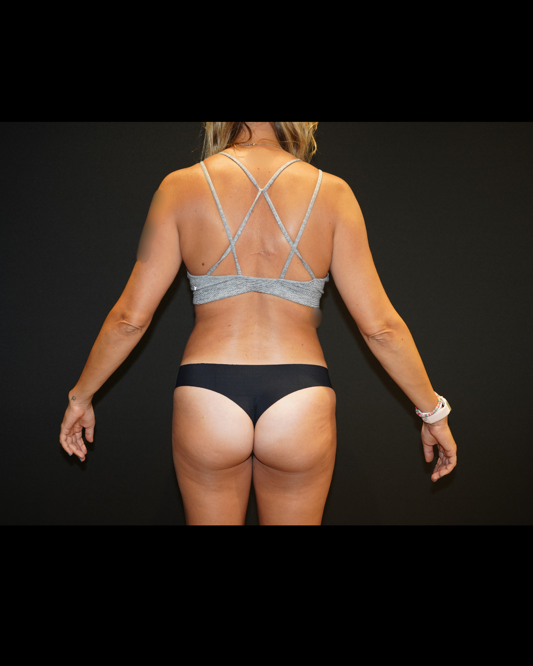 Case--8958 | After Tummy Tuck 3