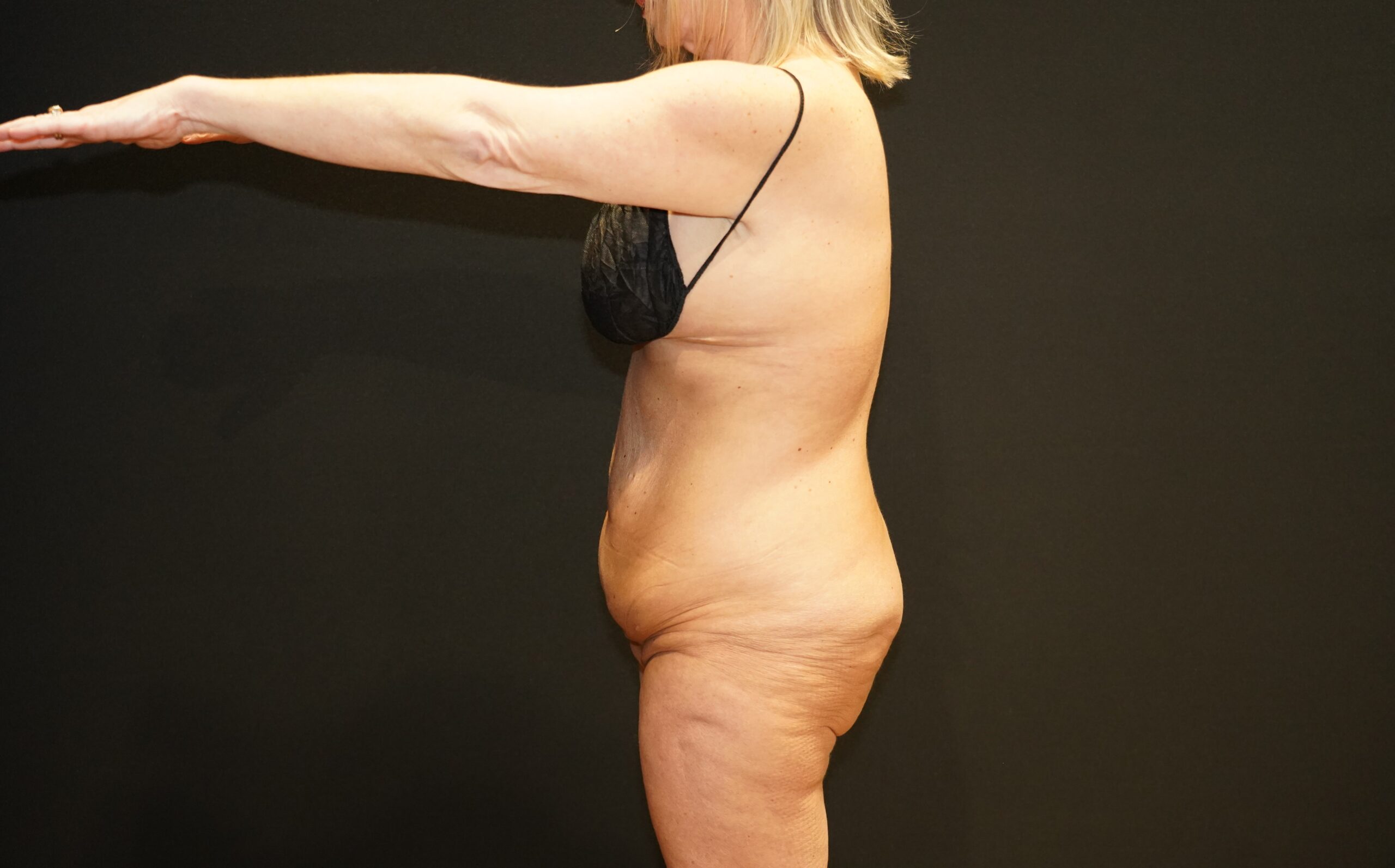 Case--8068 | Before Tummy Tuck 5