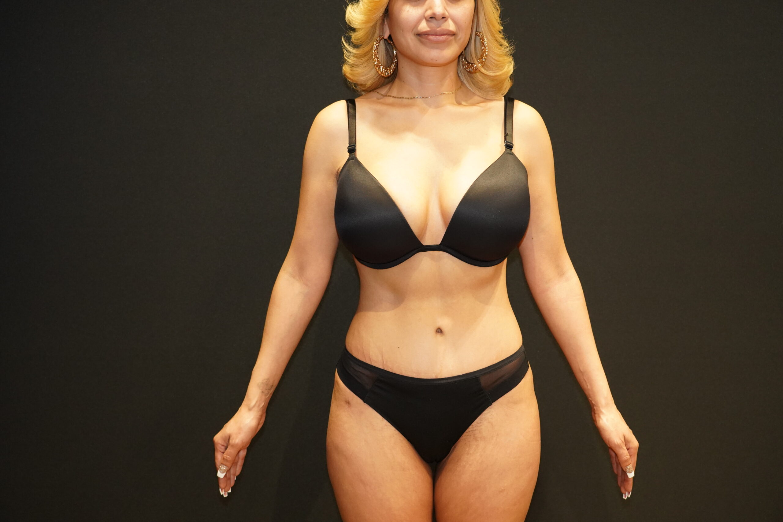 Case--9979 | After Tummy Tuck