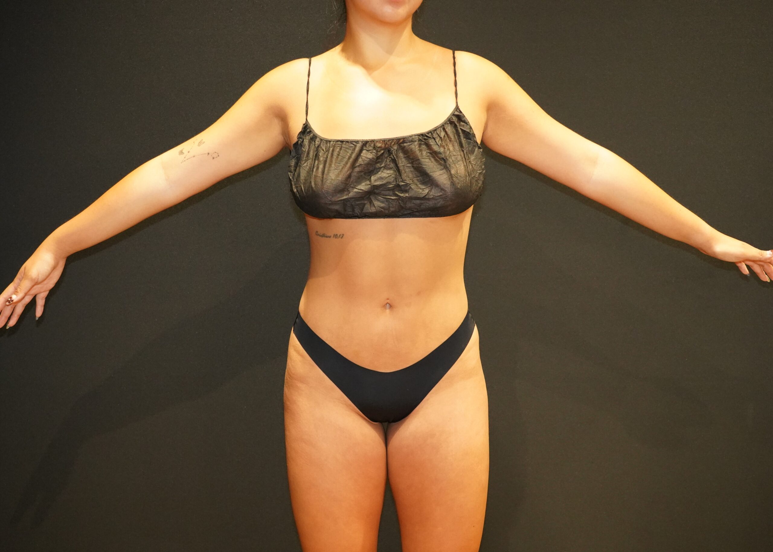 Case--9275 | After Body Liposuction & Contouring