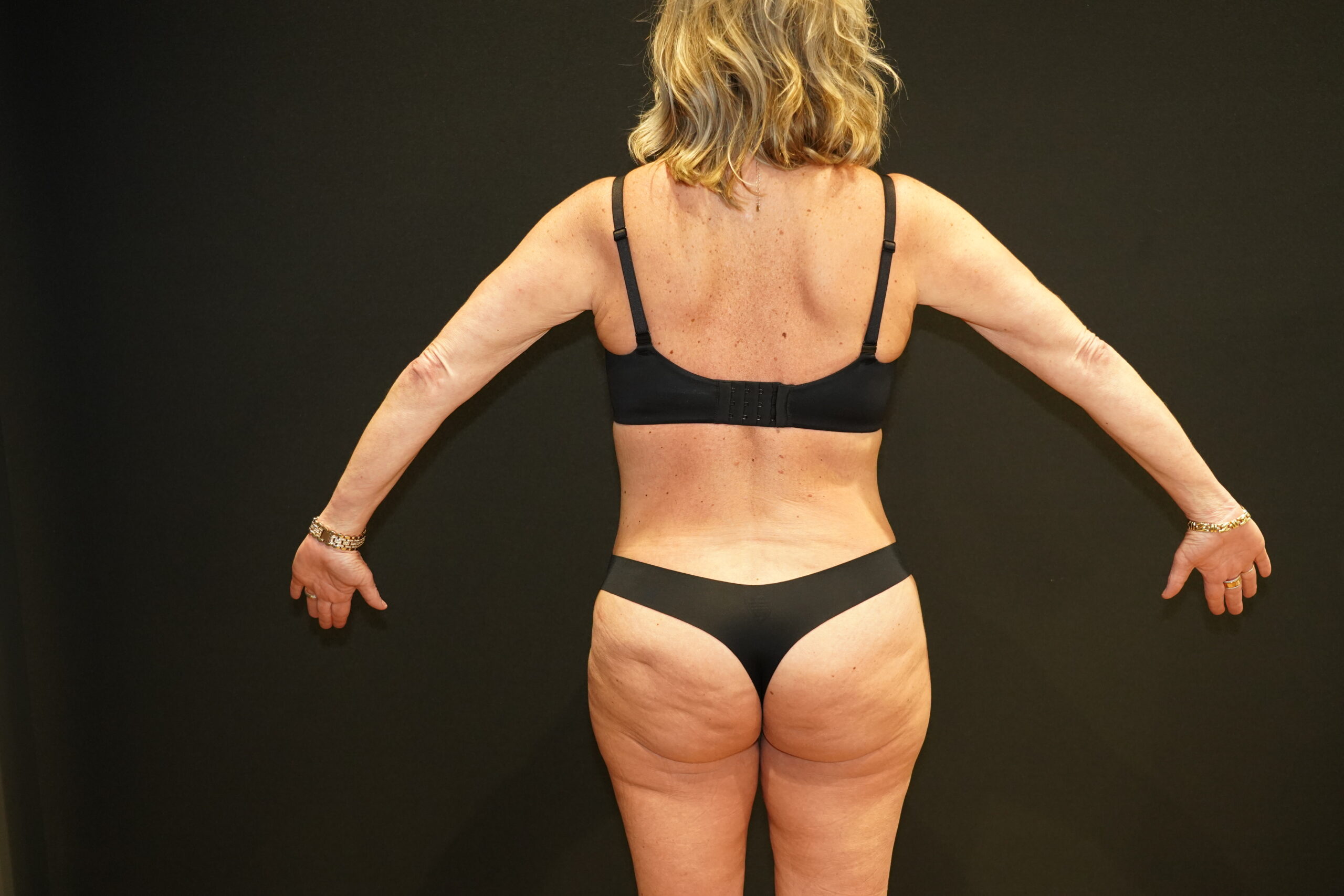 Case--8068 | After Tummy Tuck 6