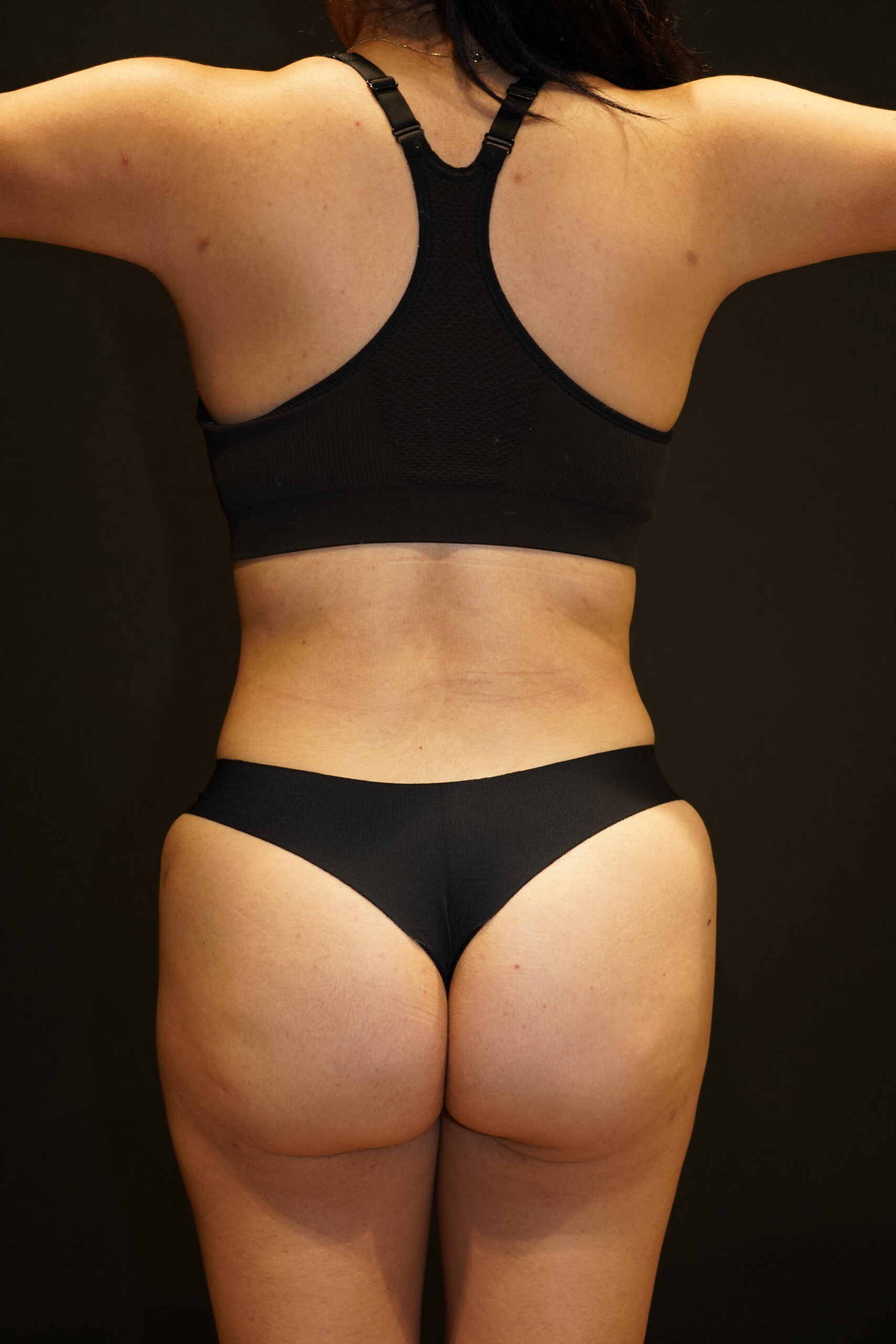 Case--6194 | After Body Liposuction & Contouring 4