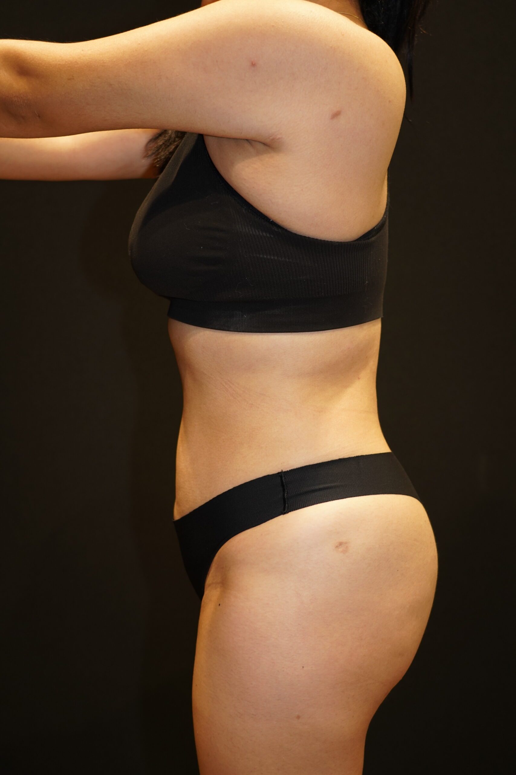 Case--6194 | After Body Liposuction & Contouring 3