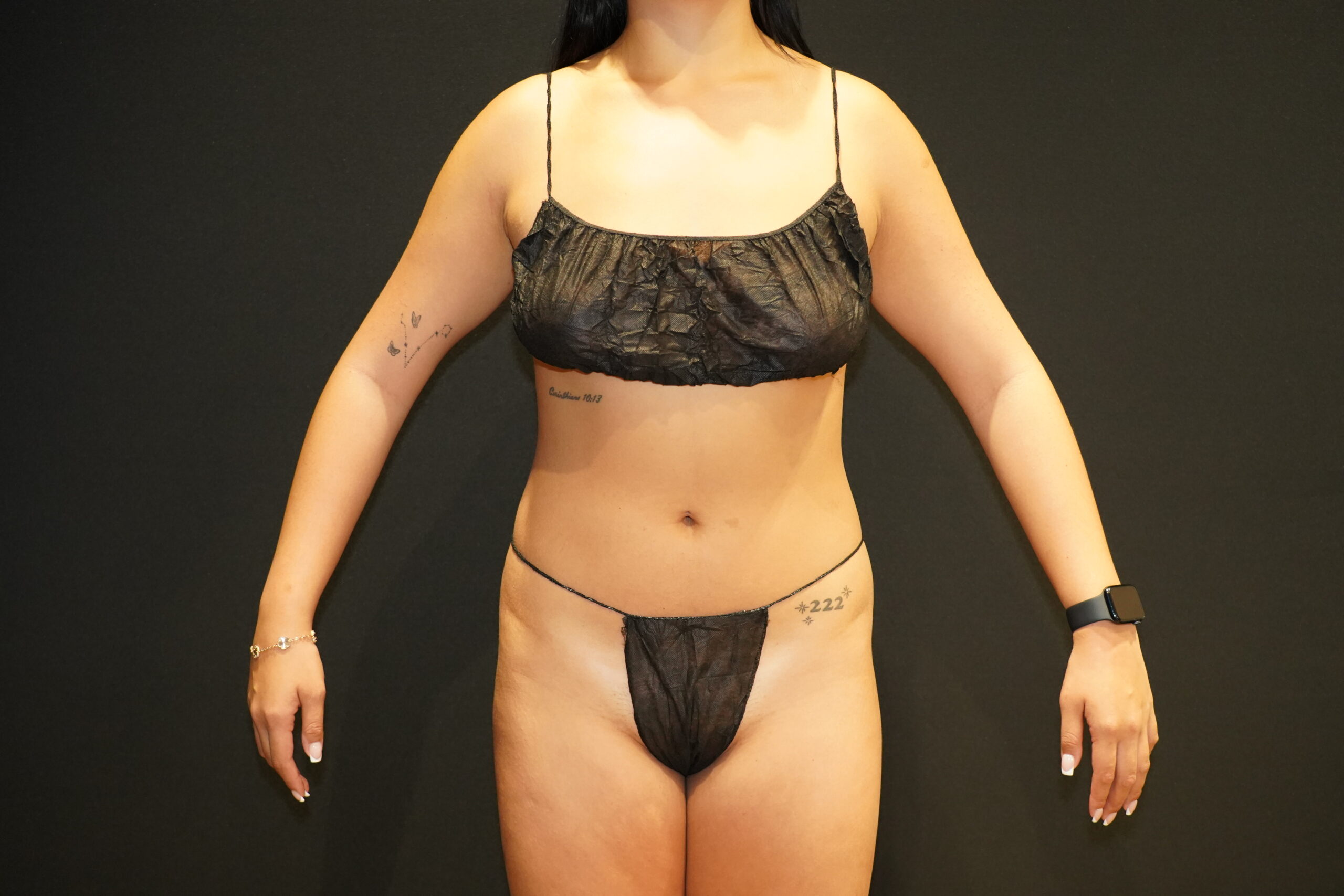 Case--9275 | Before Body Liposuction & Contouring