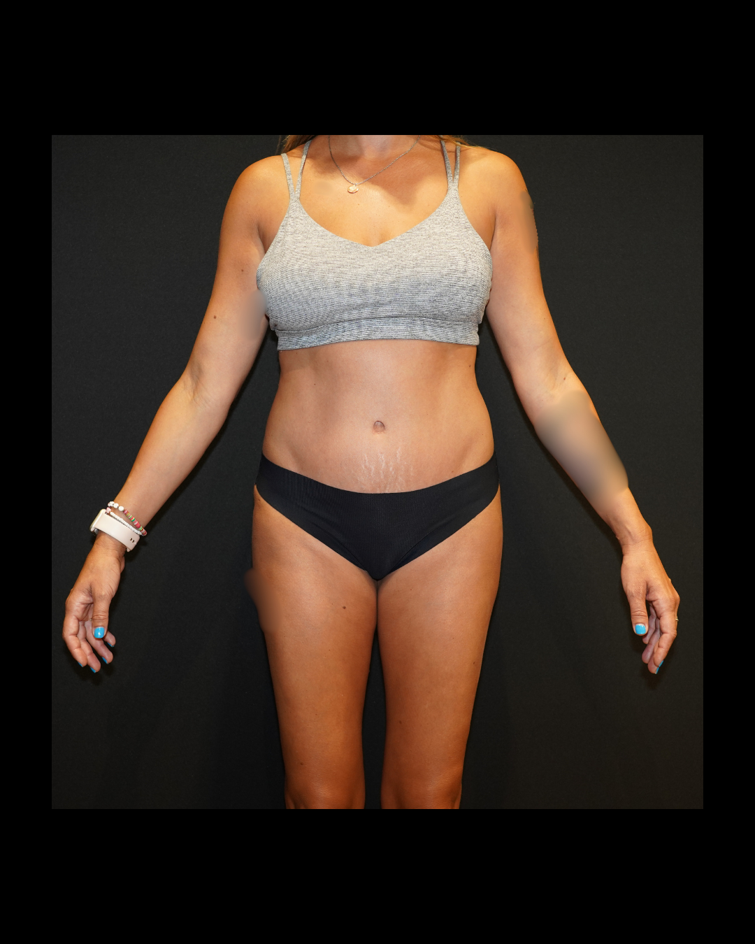 Case--8958 | After Tummy Tuck